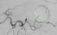 Cầm máu thành công ca ung thư dạ dày biến chứng