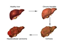 FDA phê chuẩn công cụ AI hỗ trợ phát triển thuốc điều trị bệnh gan mãn tính