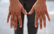 Anh ghi nhận ca đầu tiên nhiễm chủng mới của virus đậu mùa khỉ