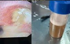 Cảnh báo hai ca viêm phổi nặng do sặc dầu