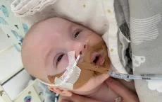 Bùng phát tình trạng ngộ độc botulinum ở trẻ sơ sinh tại Mỹ