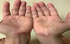 Tê bì bàn tay kéo dài - cảnh báo hội chứng ống cổ tay