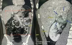 Tiểu hồng kéo dài, nam thanh niên 19 tuổi phát hiện u thượng thận 6 cm