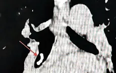 Phát hiện dị vật phế quản hiếm gặp sau hơn 1 tháng điều trị không hiệu quả