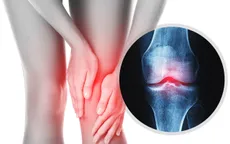 Những thói quen giúp bảo vệ đầu gối, hạn chế nguy cơ thoái hóa khi về già