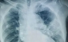 Viêm phổi do nấm Candida albicans ở người cao tuổi