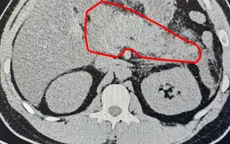 Viêm tụy cấp do tăng triglycerid máu: Bệnh lý nguy hiểm