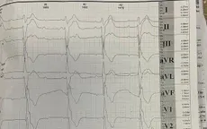 Hội chứng Kearns-Sayre - bệnh di truyền hiếm đe dọa tim mạch ở người trẻ