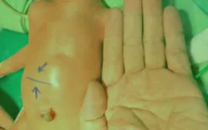 Viêm ruột hoại tử đe dọa tính mạng trẻ sinh non