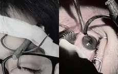 Nguy cơ mất thị lực do móc câu cá cắm vào mắt