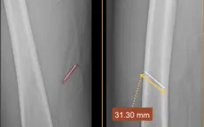 Gắp dị vật kim loại sâu do tai nạn lao động