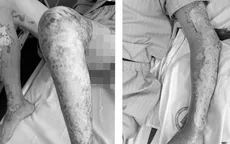 Bỏng nặng khi đốt đồ cũ