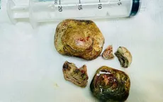 Lấy sỏi bàng quang lớn cho bệnh nhân nhiều bệnh nền