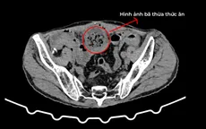 Cứu bệnh nhân tắc ruột do bã thức ăn