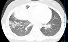 14 ngày điều trị cho bé gái bị viêm phổi thùy nặng