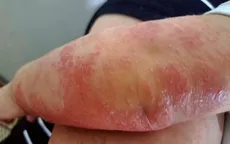 Viêm da cơ địa mùa lạnh: Không chủ quan và tự ý điều trị