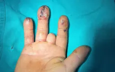 Cảnh báo tai nạn dây curoa cuốn tay, nguy cơ mất chức năng chi trên