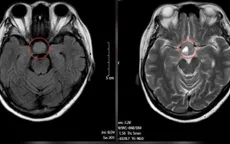 Nhìn mờ kéo dài, phát hiện u tuyến yên nguy hiểm