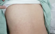 Người lớn cũng có thể mắc sởi, tiêm phòng là biện pháp phòng ngừa hiệu quả