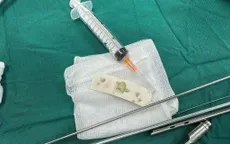 Cơn ho sặc ở trẻ nhỏ: Nguy cơ dị vật đường thở bị bỏ quên