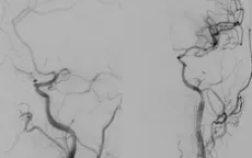 Gia tăng số ca nhập viện do đột quỵ não