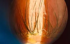 Cảnh báo nguy cơ tổn thương mắt do nối mi giả