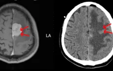 Loại bỏ u màng não liềm não bằng kỹ thuật vi phẫu hiện đại