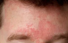 Những bệnh da thường gặp trong mùa lạnh