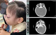 Áp xe ổ mắt do viêm xoang kháng kháng sinh