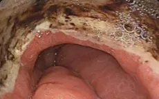 Cẩn trọng với các cơn đau bụng