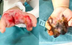 Cứu bàn tay hoại tử do máy tuốt lúa cho bệnh nhi 8 tháng tuổi