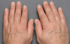 Đừng chủ quan với dấu hiệu bệnh to đầu chi