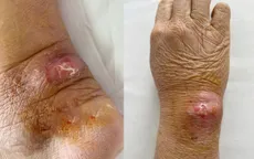 Mắc bệnh dại sau khi bị mèo cào