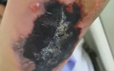 Ghép da điều trị hoại tử da ngay tại tuyến cơ sở