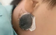 Nhận biết sớm bệnh quai bị ở trẻ em