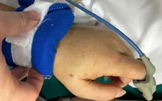 Cảnh báo ca viêm màng não do não mô cầu nguy hiểm