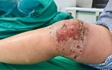 Đắp thuốc nam chữa đau khớp: Nguy cơ nhiễm trùng da