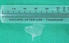 Xử trí an toàn ca hóc xương cá mắc sâu hạ họng