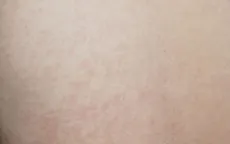 Ngành Y tế Điện Biên khuyến cáo chủ động phòng, chống bệnh sởi