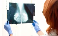 Xét nghiệm máu giúp dự đoán hiệu quả điều trị ung thư vú