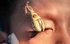 Cảnh báo tai nạn khi câu cá: Nguy cơ mù mắt vì lưỡi câu