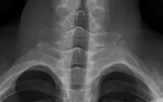 Đau cột sống cổ kéo dài ở người trẻ: Đừng chủ quan với viêm cột sống dính khớp