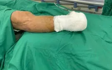 Đau chân tưởng bệnh tuổi già, cụ ông phải cắt cụt chi vì xơ vữa động mạch