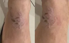 Ấu trùng "vẽ đường" ngoằn ngoèo dưới da người phụ nữ