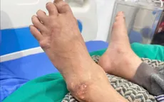 Lạm dụng corticoid khiến gout, viêm khớp diễn biến nặng