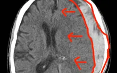 Tụ máu não sau cú ngã tưởng nhẹ