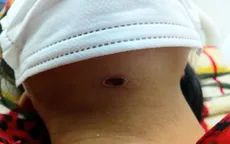 Sốt mò: Chủ quan có thể dẫn đến sốc nhiễm khuẩn, suy đa tạng