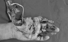 Nguy cơ mất toàn bộ bàn tay trái vì pháo nổ