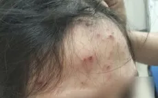 Phòng tránh nguy cơ mắc thủy đậu trong mùa đông xuân