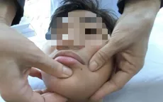 Trời rét đột ngột, gia tăng ca liệt dây thần kinh số VII ngoại biên